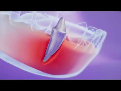 BiteOn dental implant explainer